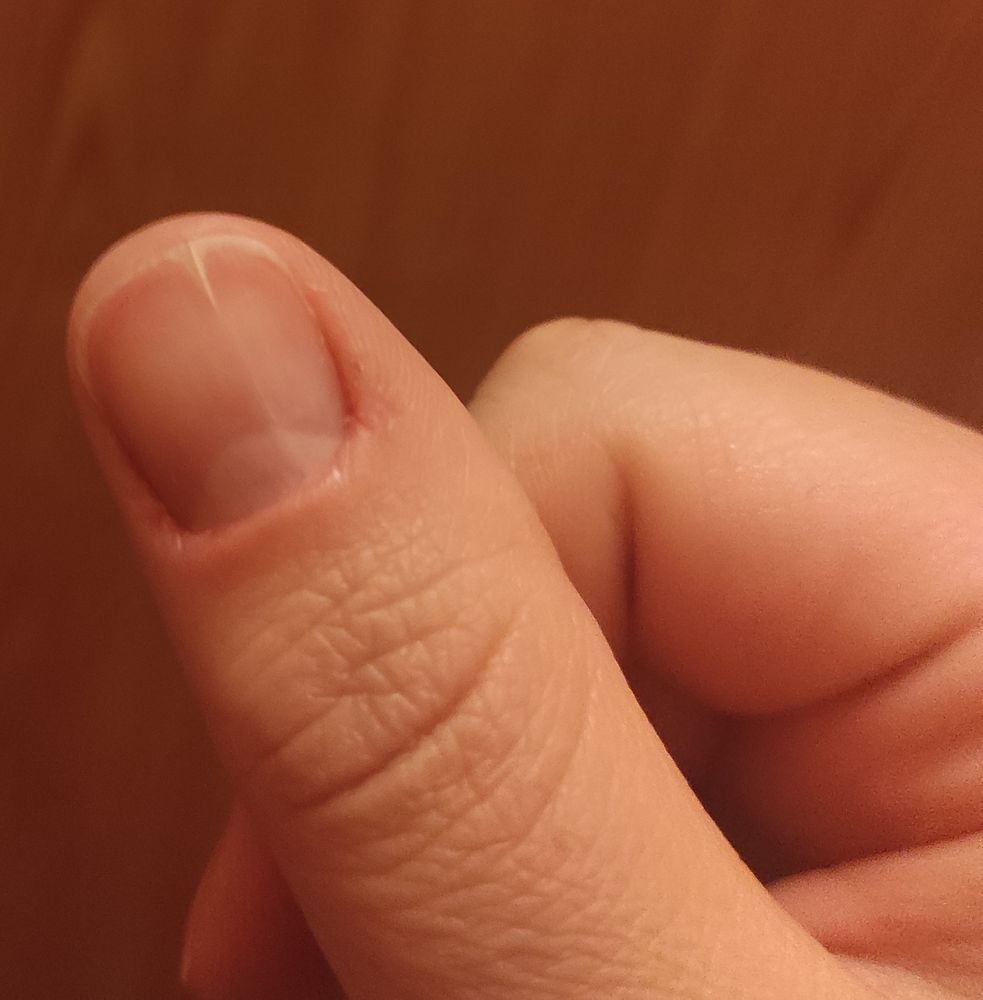 Расщипление ногтя (онихорексис). — 13 ответов | форум Babyblog