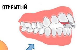 «Правда ли, что пустышки портят прикус у детей?»