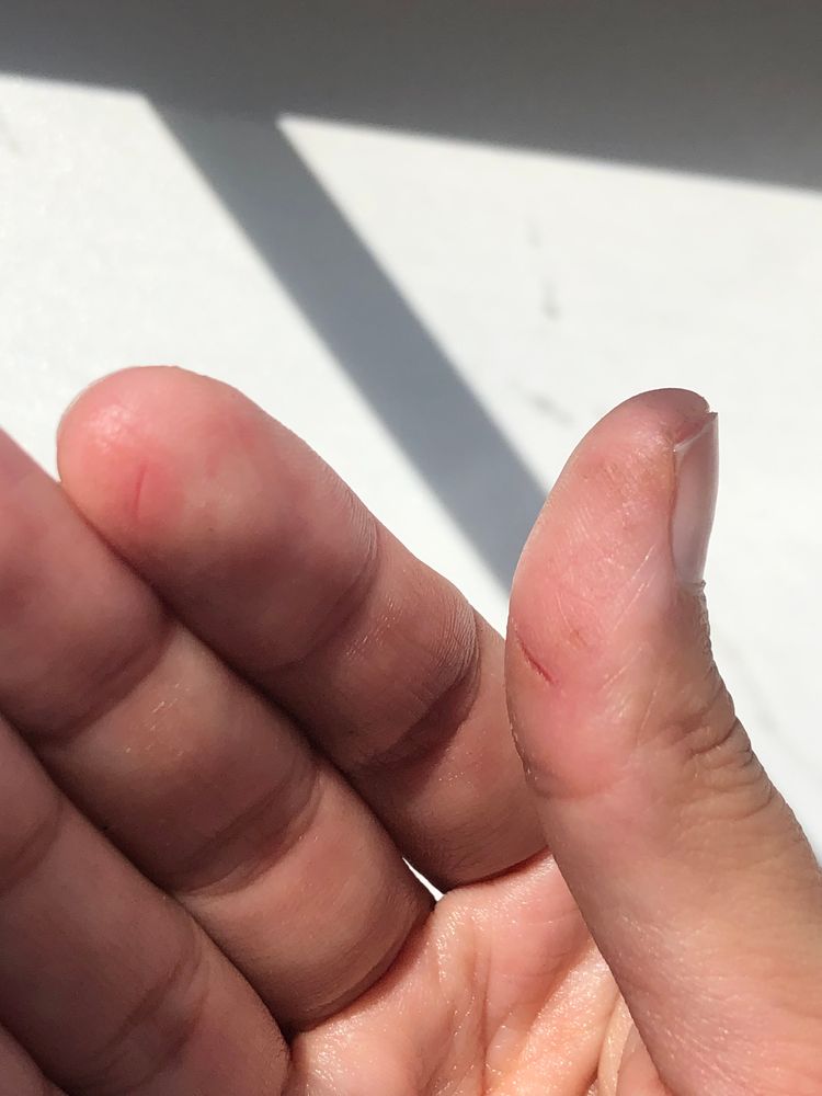 Почему возникают трещины на пальцах