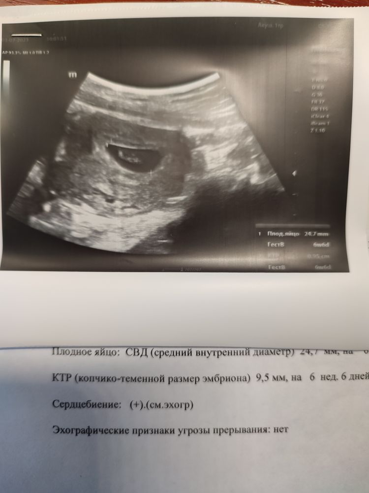 5 недель после ЭКО - размеры эмбриона, ощущения