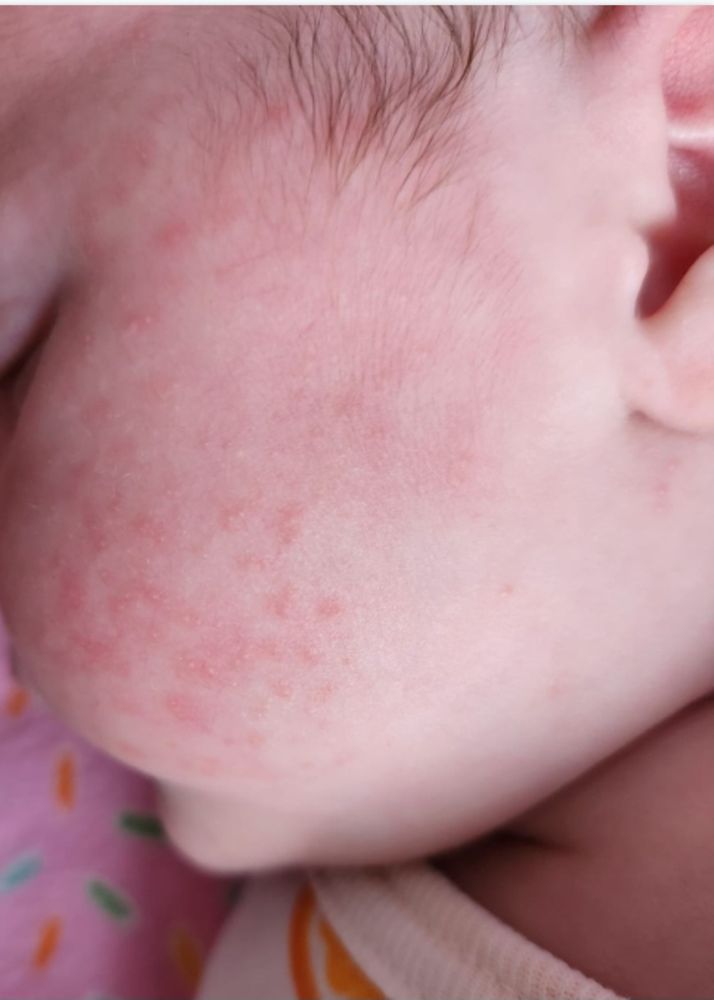 Фото аллергии на порошок у новорожденных детей