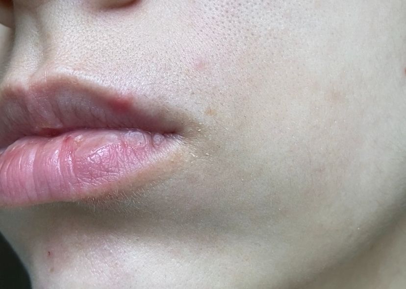 Простуда на губах: почему появляется и как лечить?