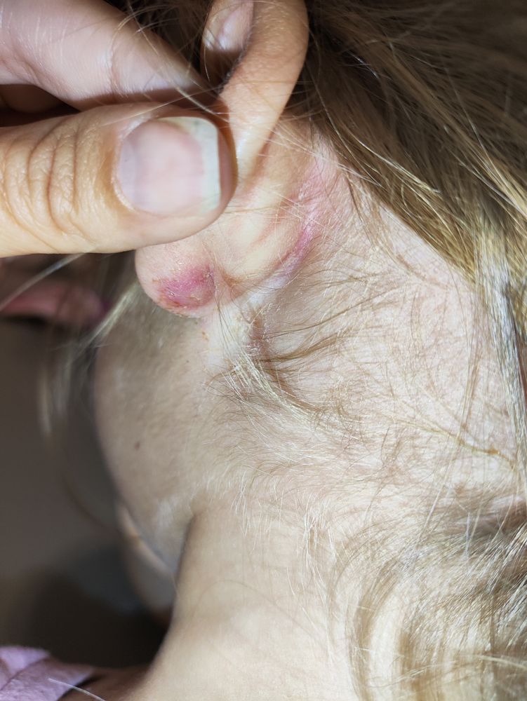 Абсцесс через 3 месяца после прокола ушей — 26 ответов