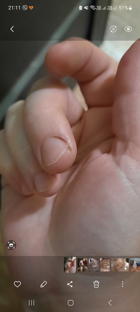Трескается кожа на пальцах рук: причины и что делать