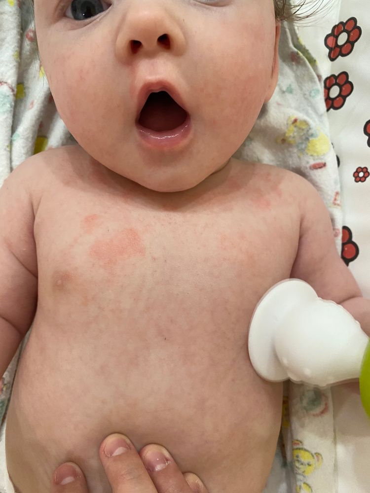 Аллергия из-за переедания ? Что это? Нам 8 месяцев — 14 ответов | форум Babyblog