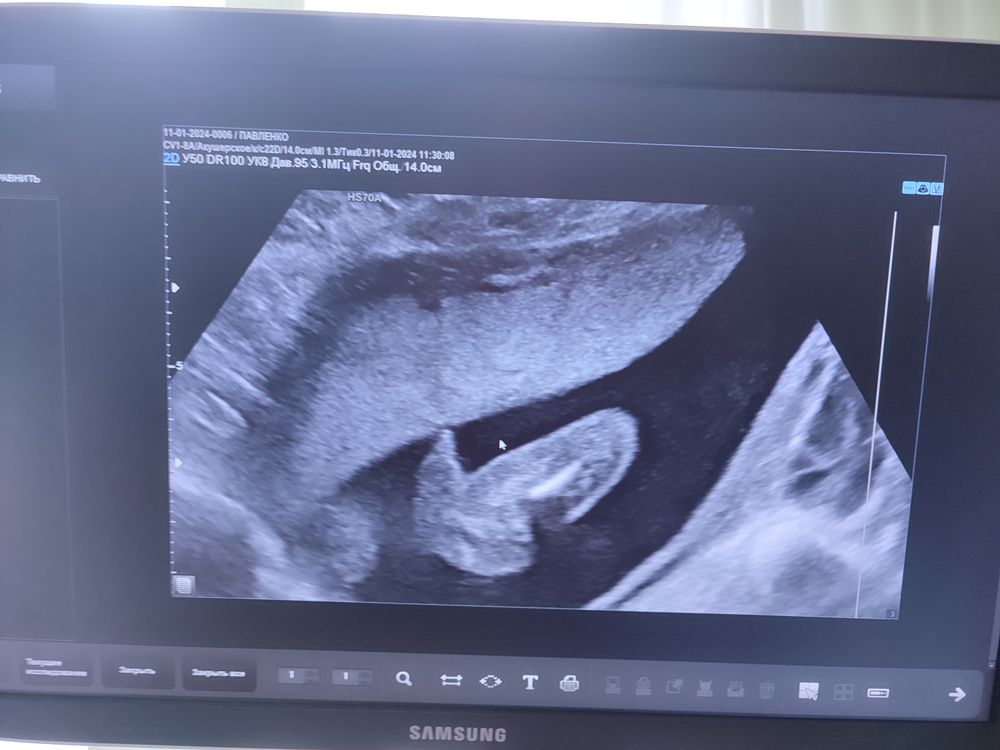 Бебиблог скрининг. Бебиблог скрининг. Скрининг. Бебиблог скрининг. Узи первый скрининг сроки.