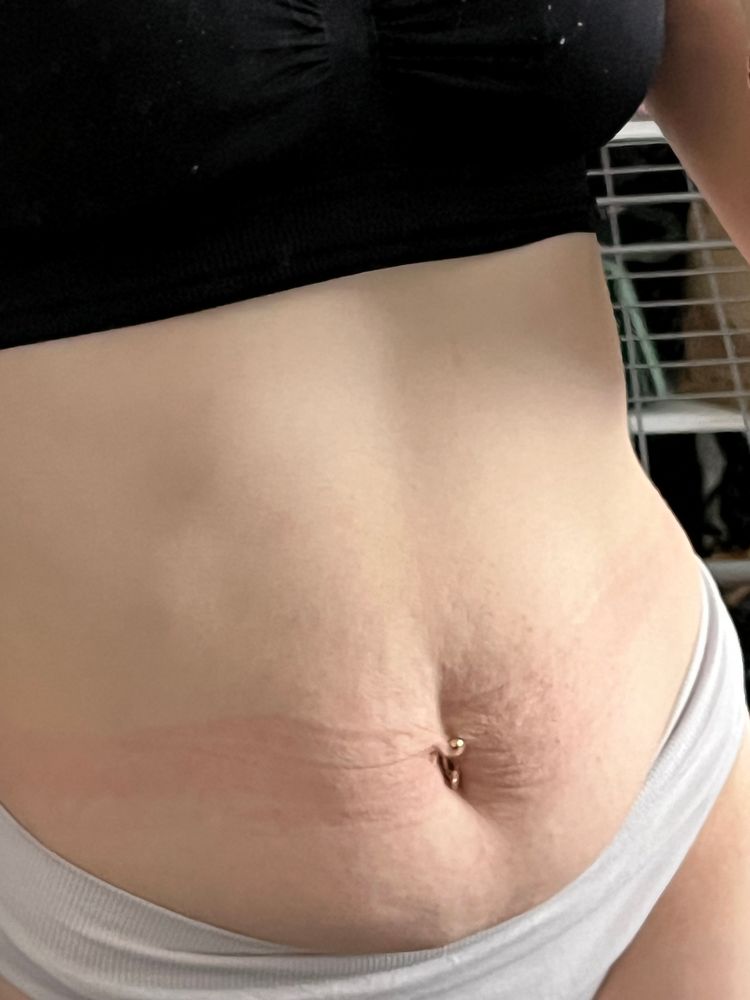 Болит живот после операции. Схема лапароскопической аппендэктомии. Послеоперационные шрамы на животе. Ложная беременность у женщин симптомы и причины. Болит живот после операции.