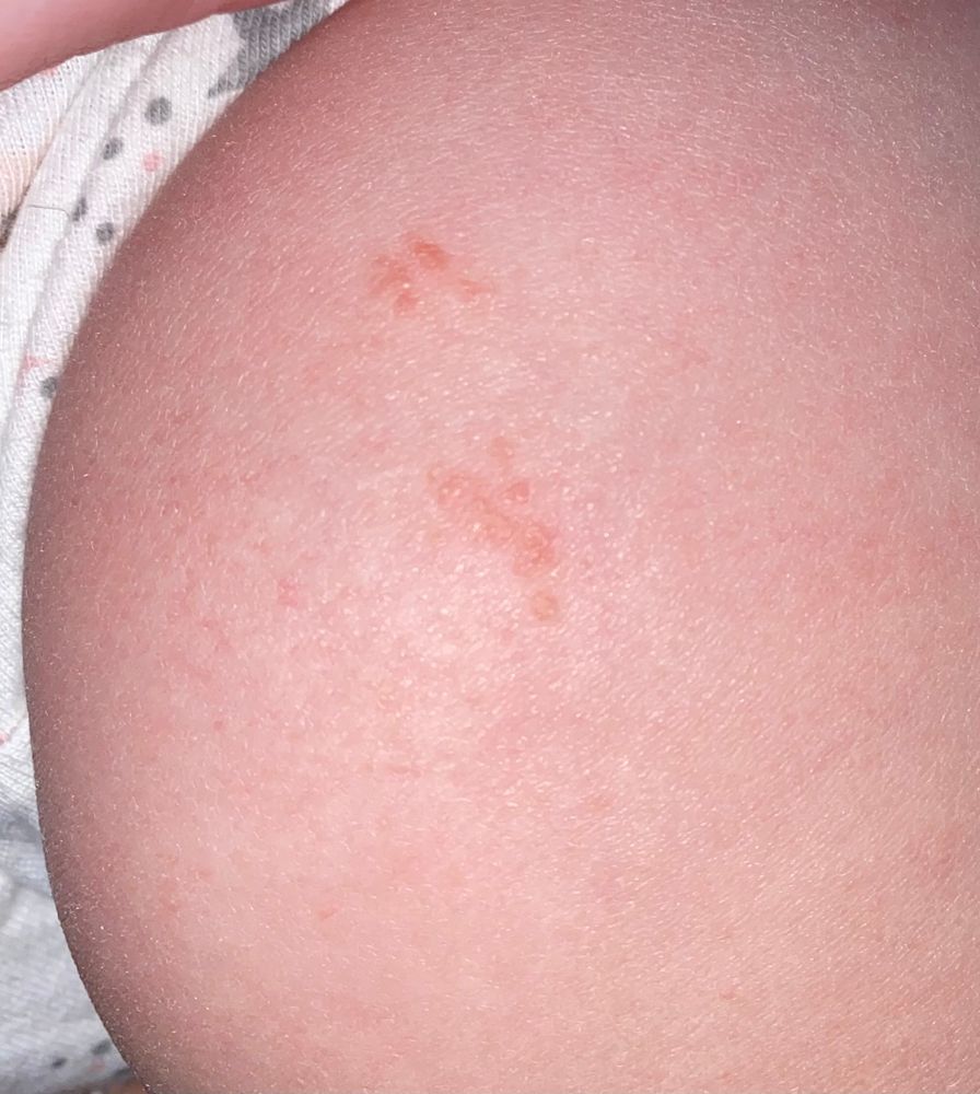 покраснение на писи у дочки Проблемы с кожей на попе — 1644 рекомендаций на Babyblog.ru