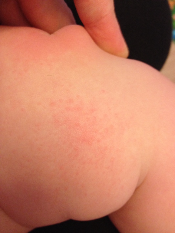 Аллергия? Не понимаю...