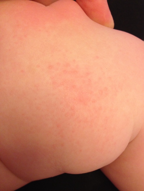 Аллергия? Не понимаю...